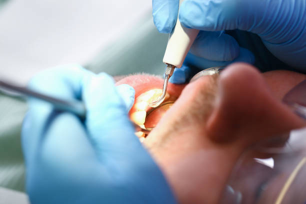 Best Emergency Tooth Extraction in Manitowoc, WI